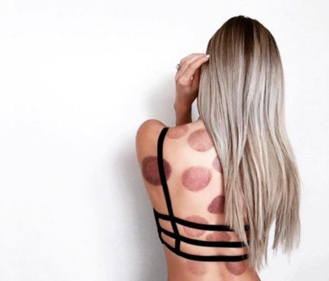 I Pulled a Michael Phelps and Tried Cupping—on My Face