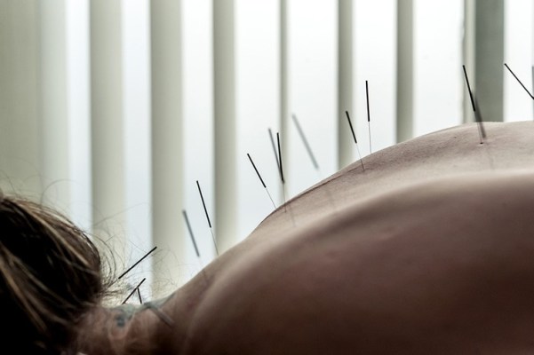 4 Things I Learned From Trying Acupuncture for the First Time