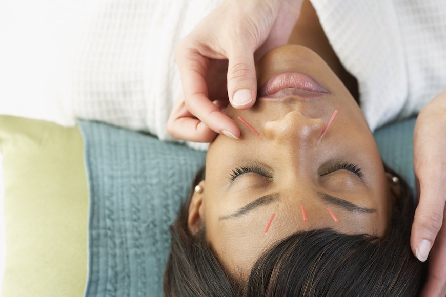 Does acupuncture work?