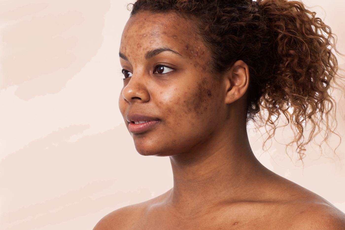 Laser Treatment For Acne On Black Skin