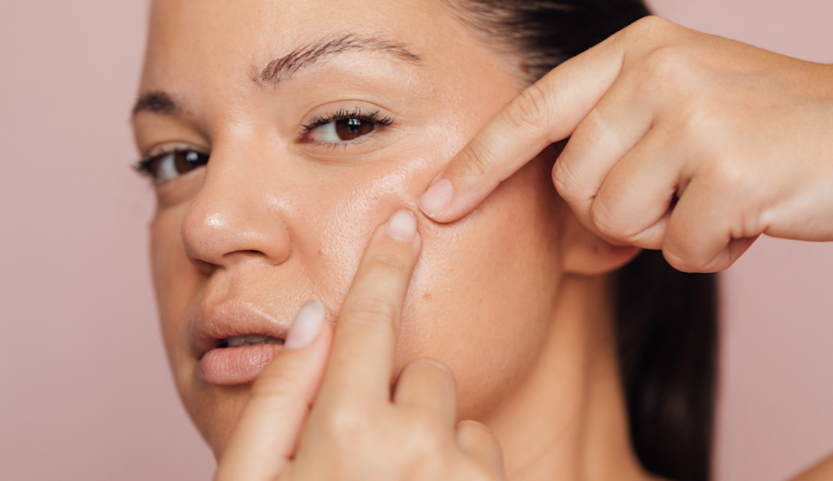 A woman pops a pimple on her face using her fingers, symbolizing pimple patches.