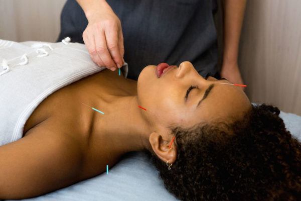 I Tried Facial Acupuncture—and Every Bit of Jaw and Forehead Tension Melted Away