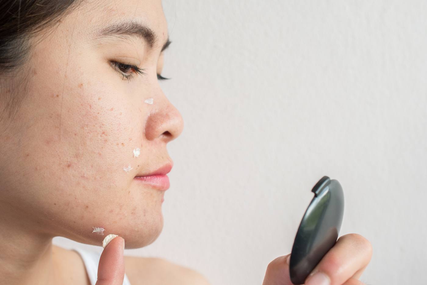 acne treatments for sensitive skin