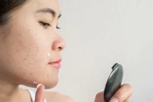 How to get rid of acne when you have sensitive skin and everything is irritating