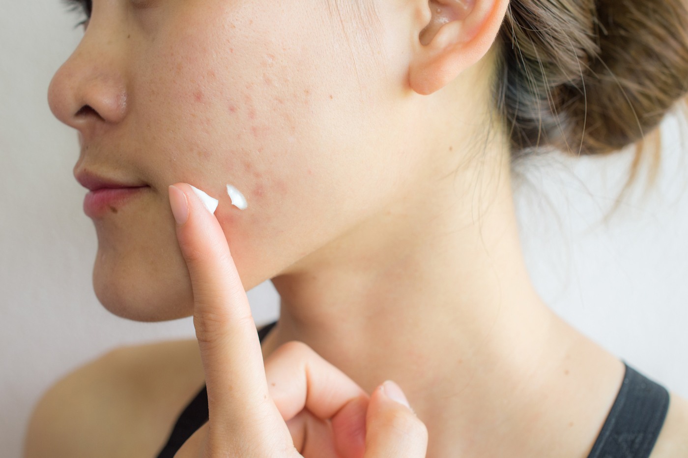 Dr. Pimple popper acne tips