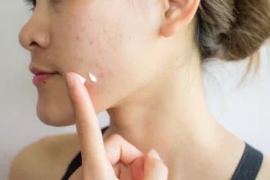 The 5 most common questions Dr. Pimple Popper gets about acne