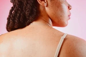 How to get rid of those pesky whiteheads, according to dermatologists