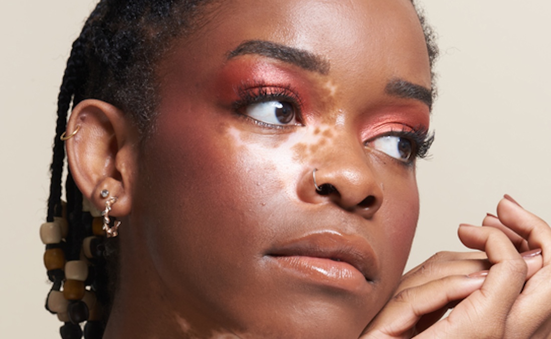 A beauty portrait highlighting the skin of a young Black woman with vitiligo. She gazes off camera resting her hands in a whimsical graceful pose under her chin.