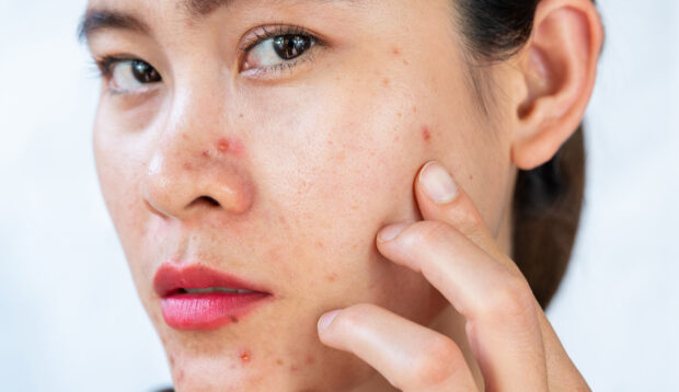 'I'm a Dermatologist, and This Is the Best Ingredient for Fighting Acne on Sensitive Skin'
