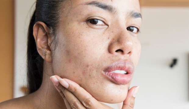 Derms Say These Are the Most Effective Ways To Clear Up Stubborn Hormonal Acne