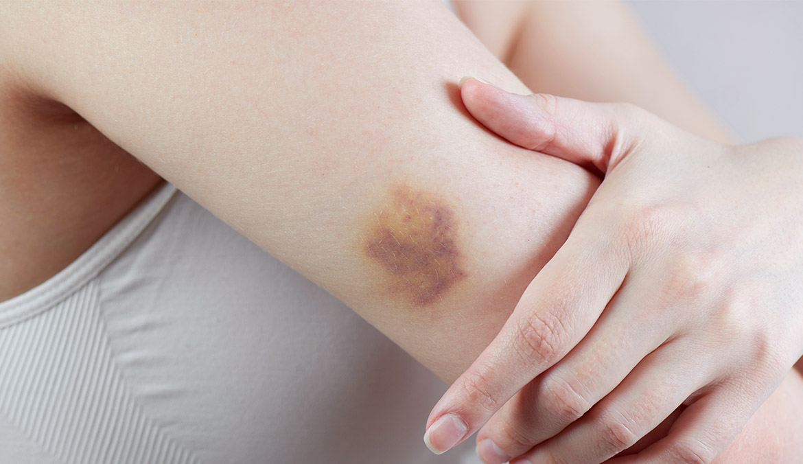how to heal a bruise fast