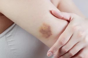 A Dermatologist Shares Their Best Tips for Healing and Fading Bruises Fast