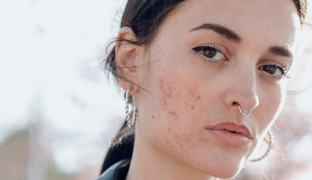 Succinic Acid Is the Little-Known Acne-Fighting Ingredient That Rivals a Retinoid—And It Won't Irritate Your...