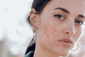 Succinic Acid Is the Little-Known Acne-Fighting Ingredient That Rivals a Retinoid—And It Won't Irritate Your Skin