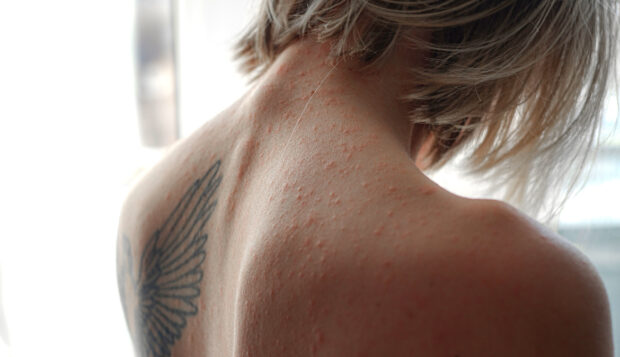 Should You Be Scared About Having a Visible Skin Condition? With Monkeypox on the Rise,...