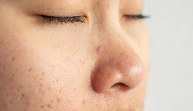 Derms Call Accutane 'The Closest Thing We Have to a Cure for Acne'—Here's Exactly What...
