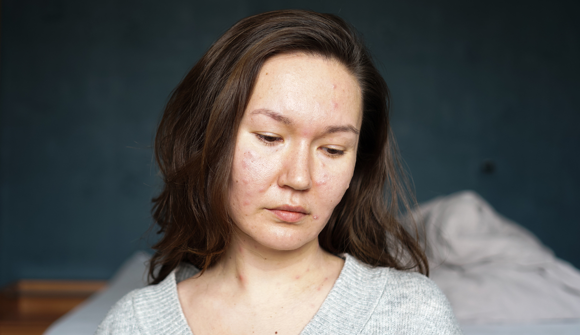 acne and inflammaging
