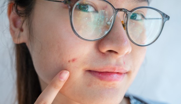 5 Dermatologists Share Their Best-Kept Secrets for Fighting Acne—And We Promise, You Haven't Heard These...