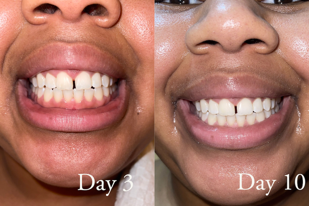 Side by side comparison of teeth whitening results on day 3 and day 10