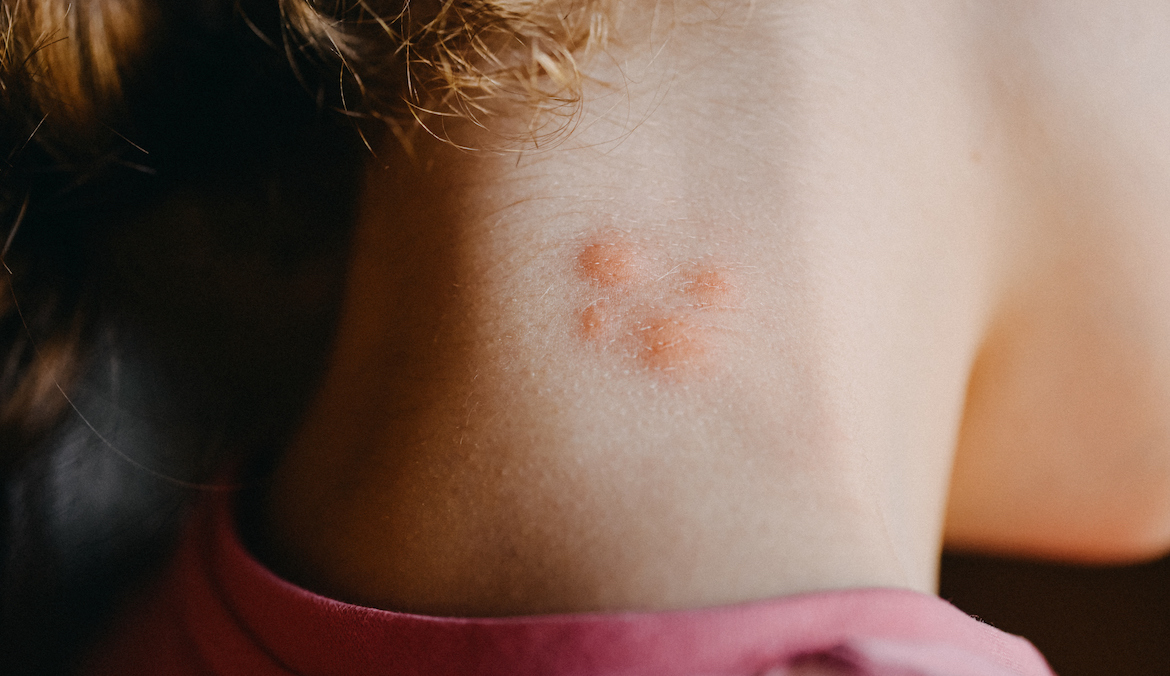 The back of a woman's neck with four red mosquito bites on it.