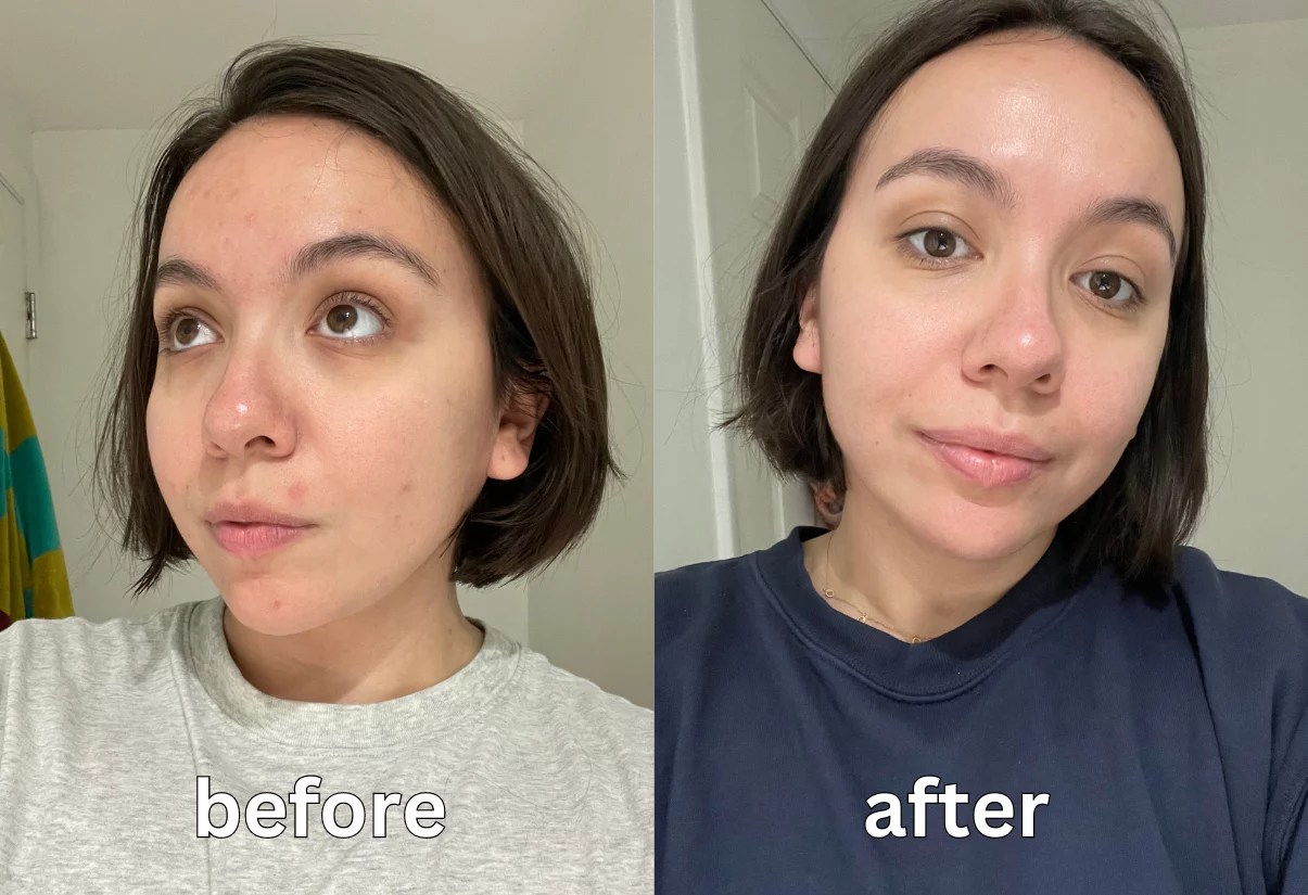 before and after photos of the beauty bio r45 the reversal retinol treatment