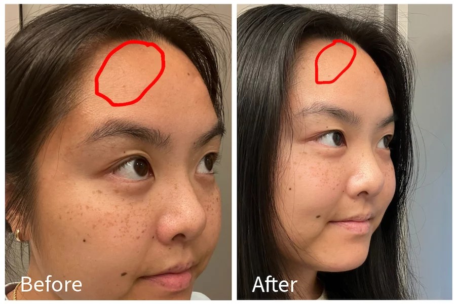 left side shows before acne treatment, right side shows results after bubbles acne treatment