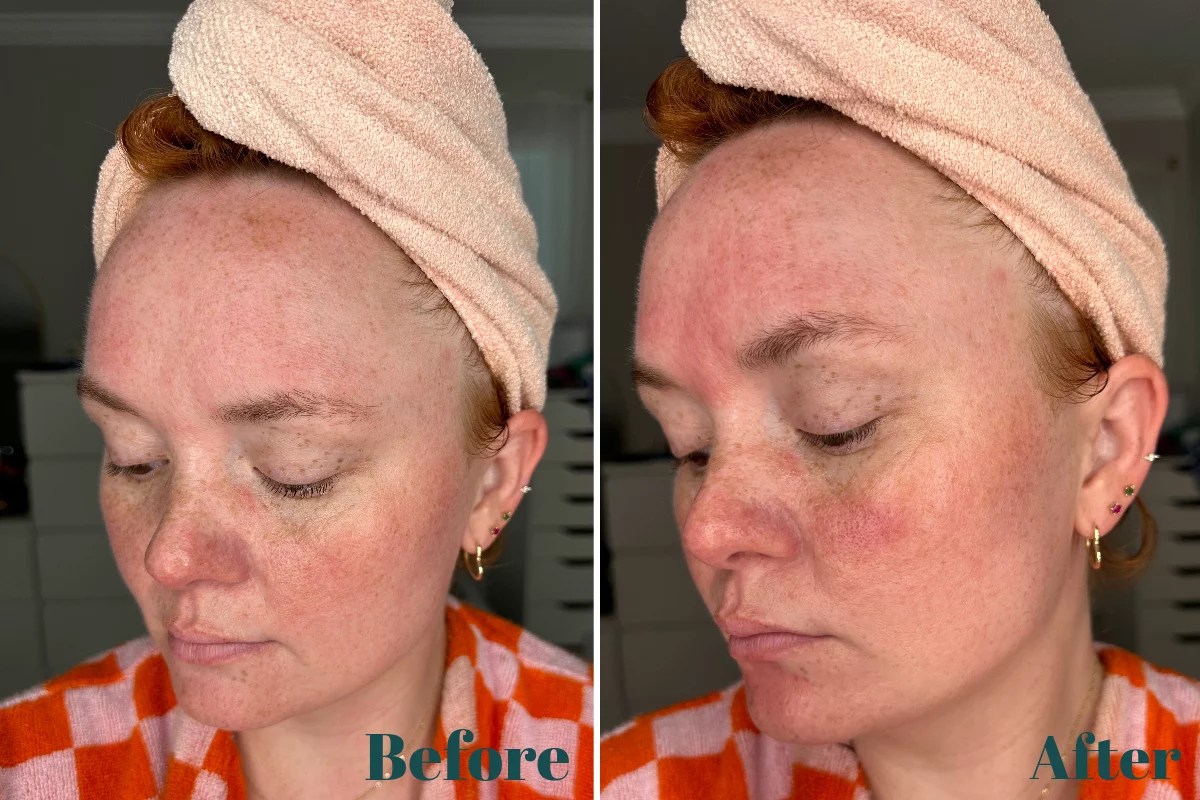 dermapore before after