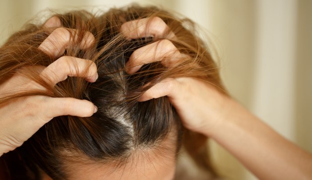 There's a Link Between Psoriasis and Hair Loss: Here's What Dermatologists Want You To Know