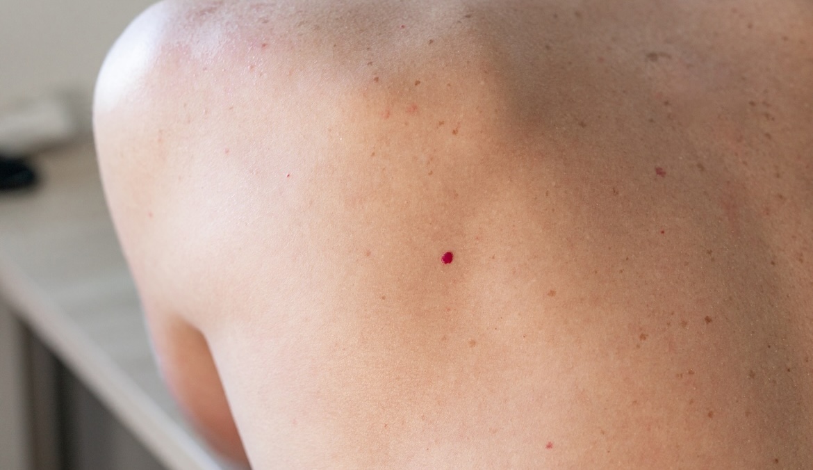 A close up of a person's back with red moles on skin after pregnancy