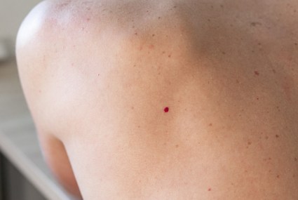 Older Than 30? You Might Start Noticing These Moles on Your Skin